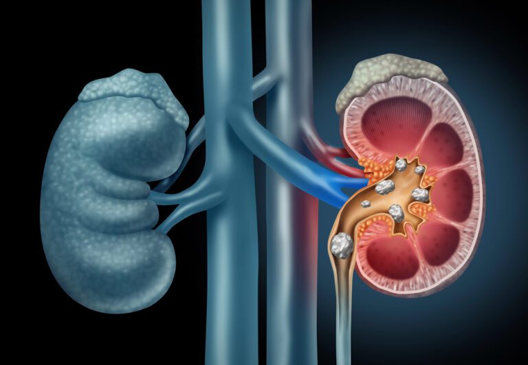 Can Ozempic Cause Kidney Stones?